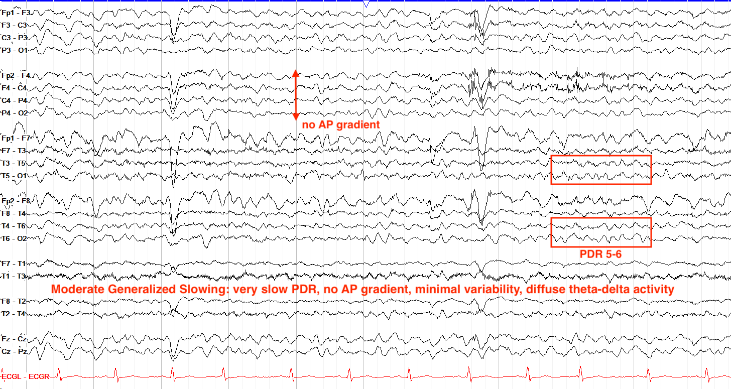 Moderate generalized slowing EEG annotated
