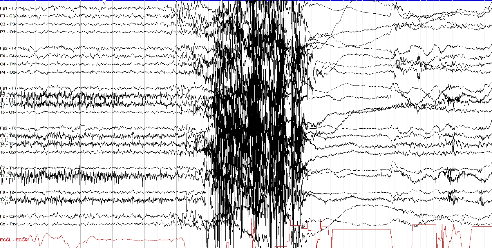Myoclonic seizure EEG OFF