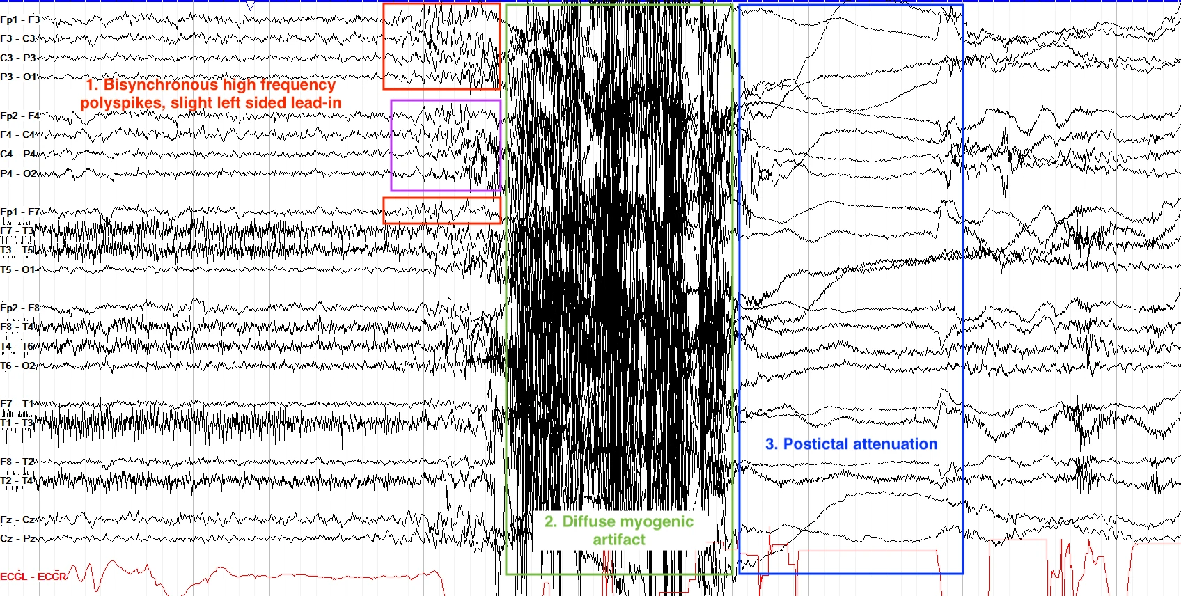 Myoclonic seizure EEG ON