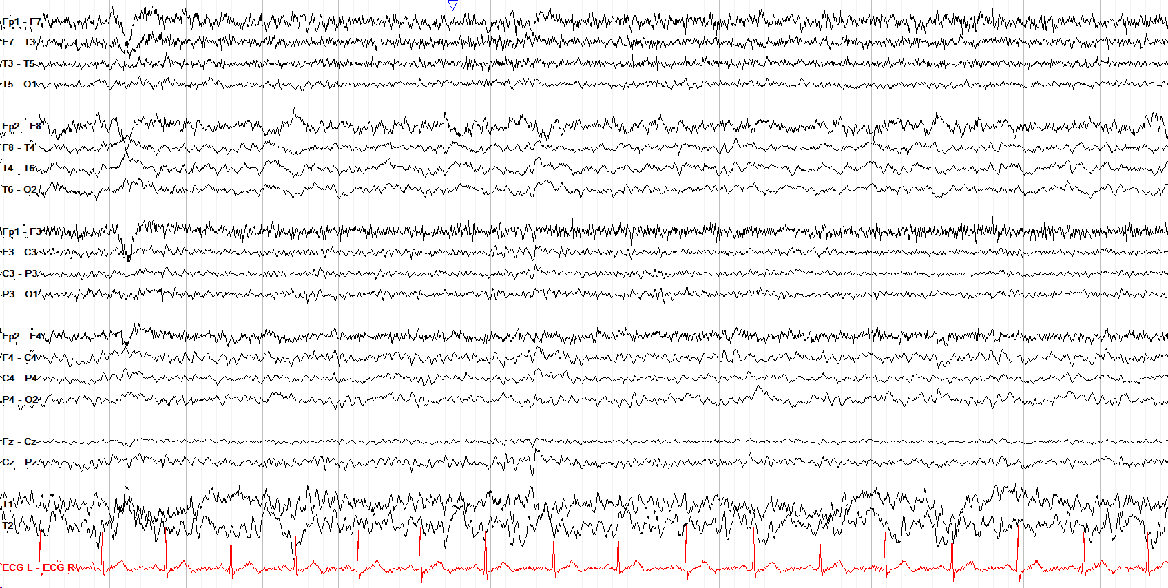 Right posterior polymorphic delta slowing EEG without annotation