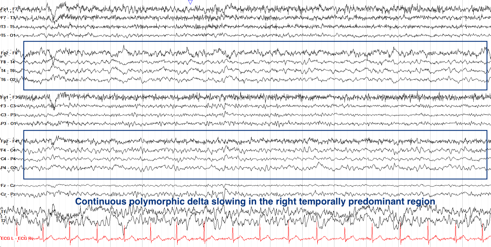 Right posterior polymorphic delta slowing EEG annotated