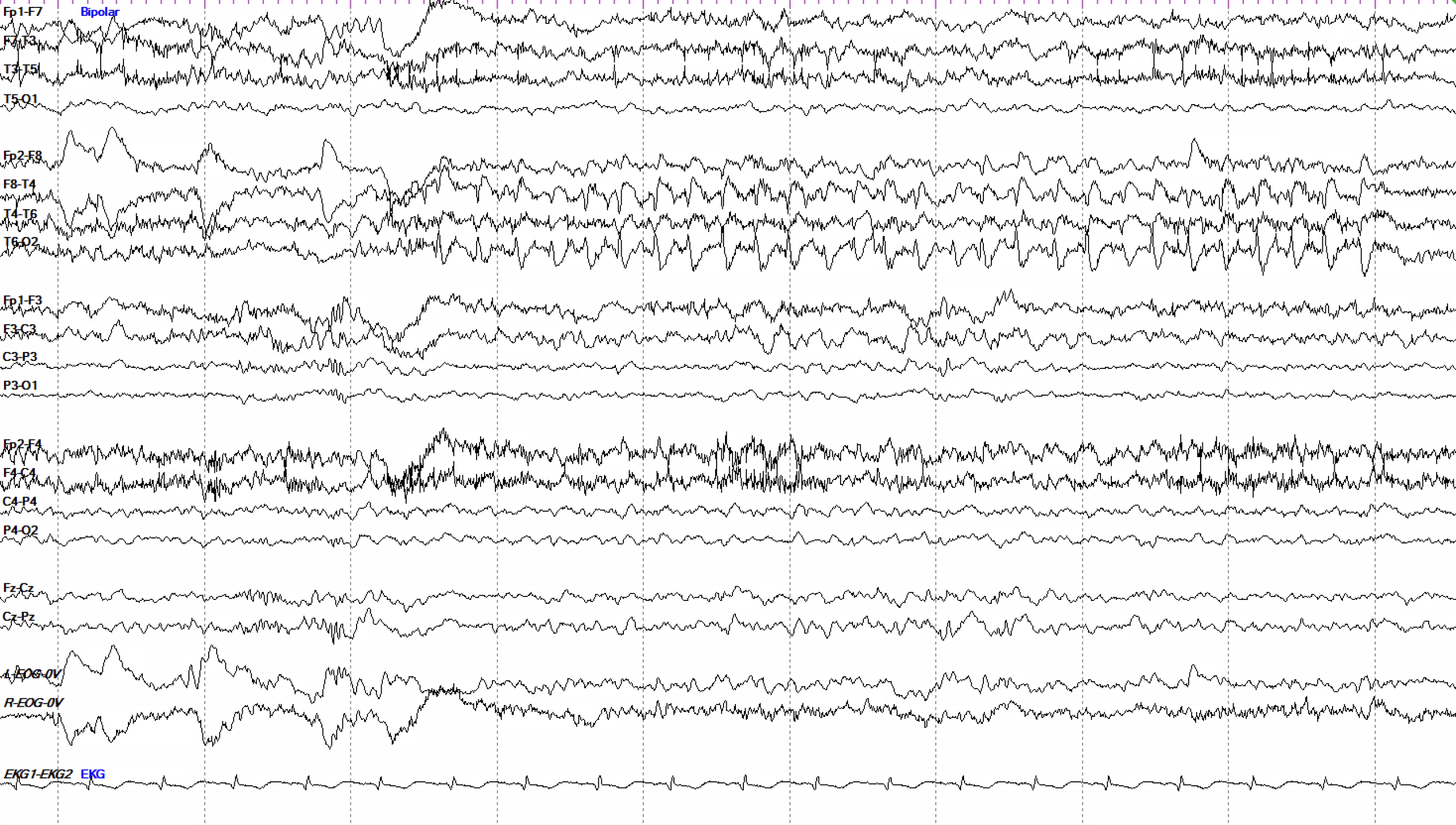 Right temporal BIRDs 4 to 5 Hz EEG OFF