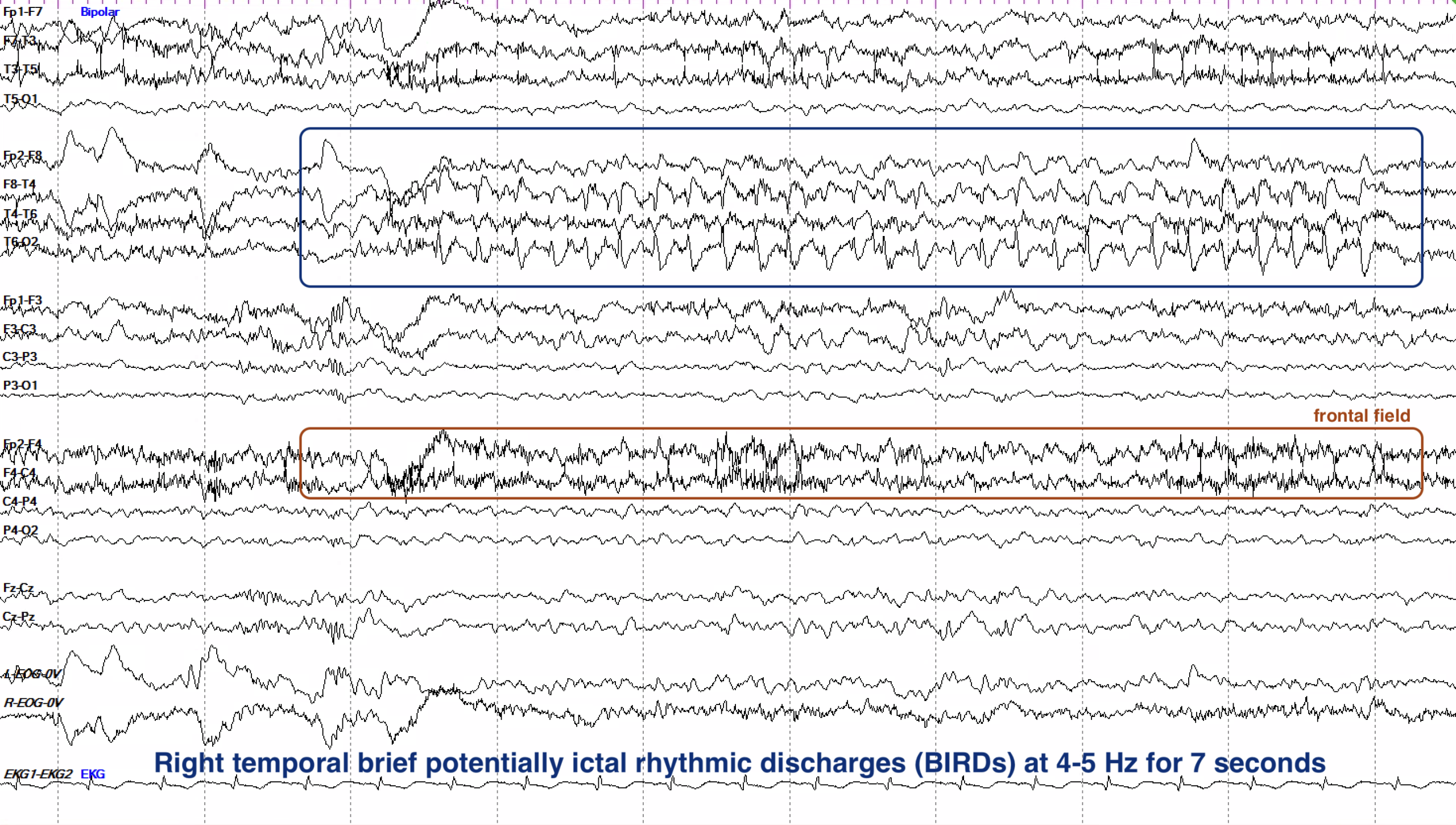 Right temporal BIRDs 4 to 5 Hz EEG ON