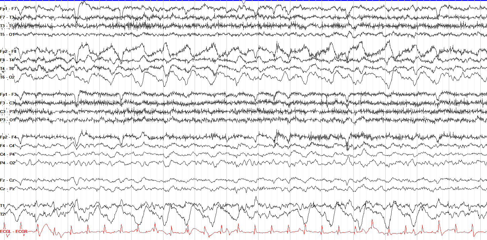 Right temporal LRDA 1.5 Hz EEG OFF