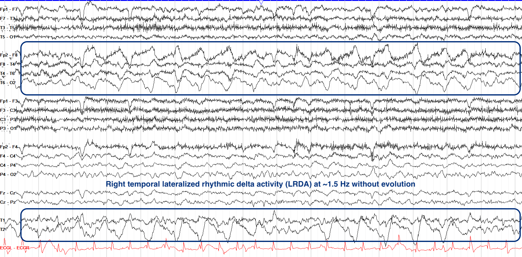 Right temporal LRDA 1.5 Hz EEG ON