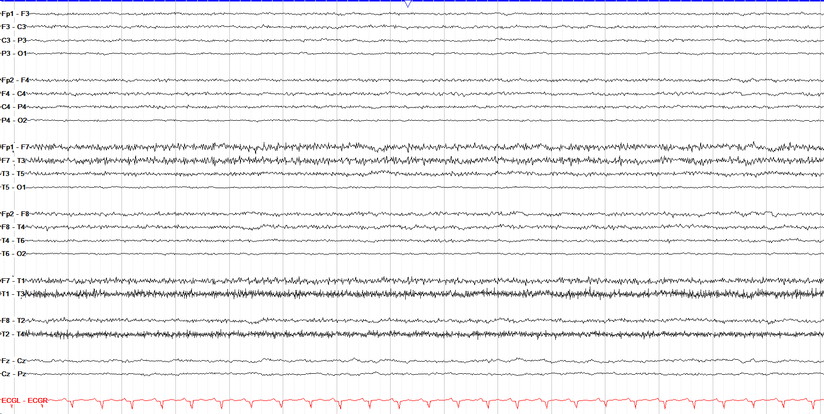 Severe generalized slowing EEG without annotation