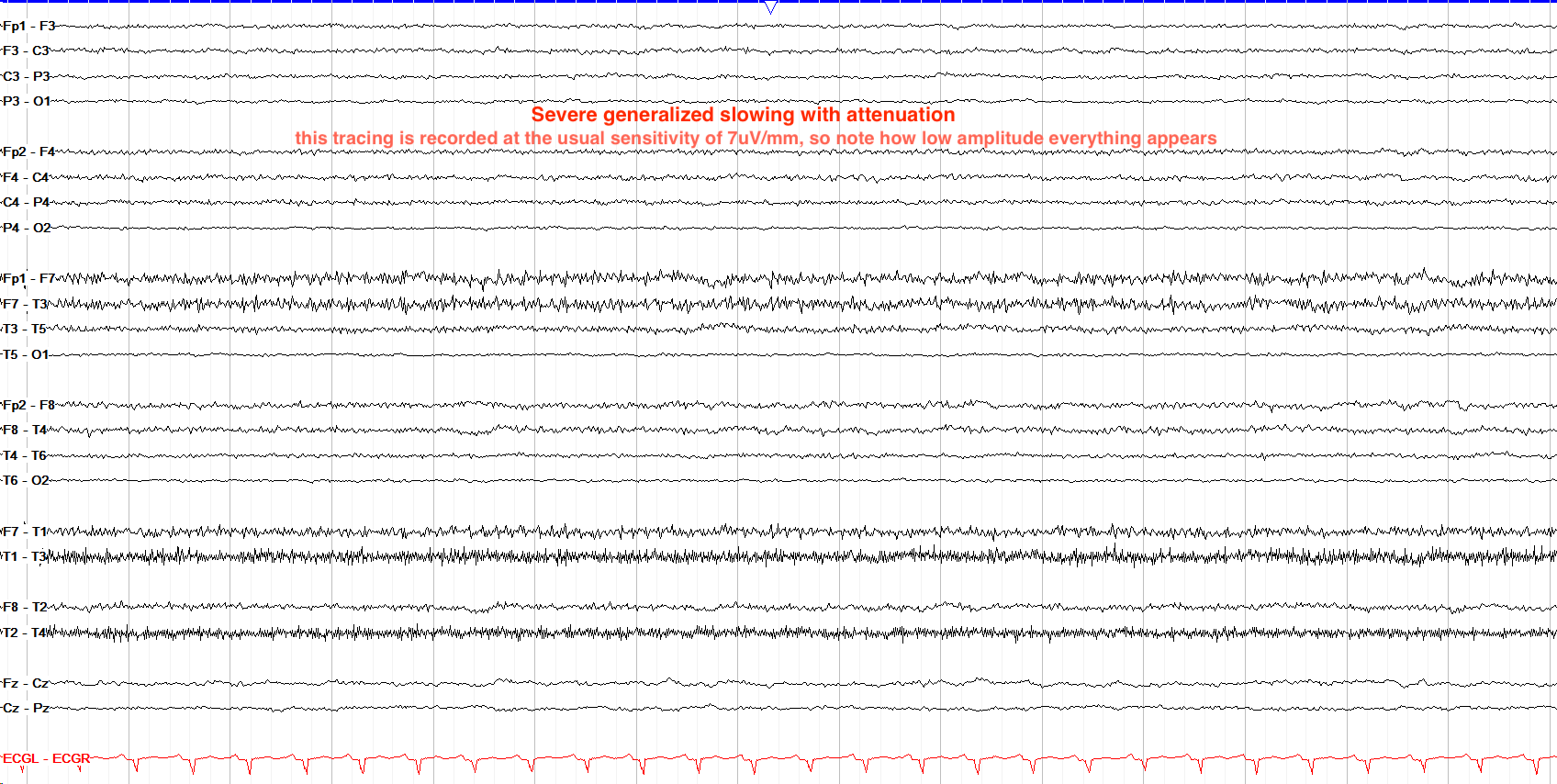 Severe generalized slowing EEG annotated