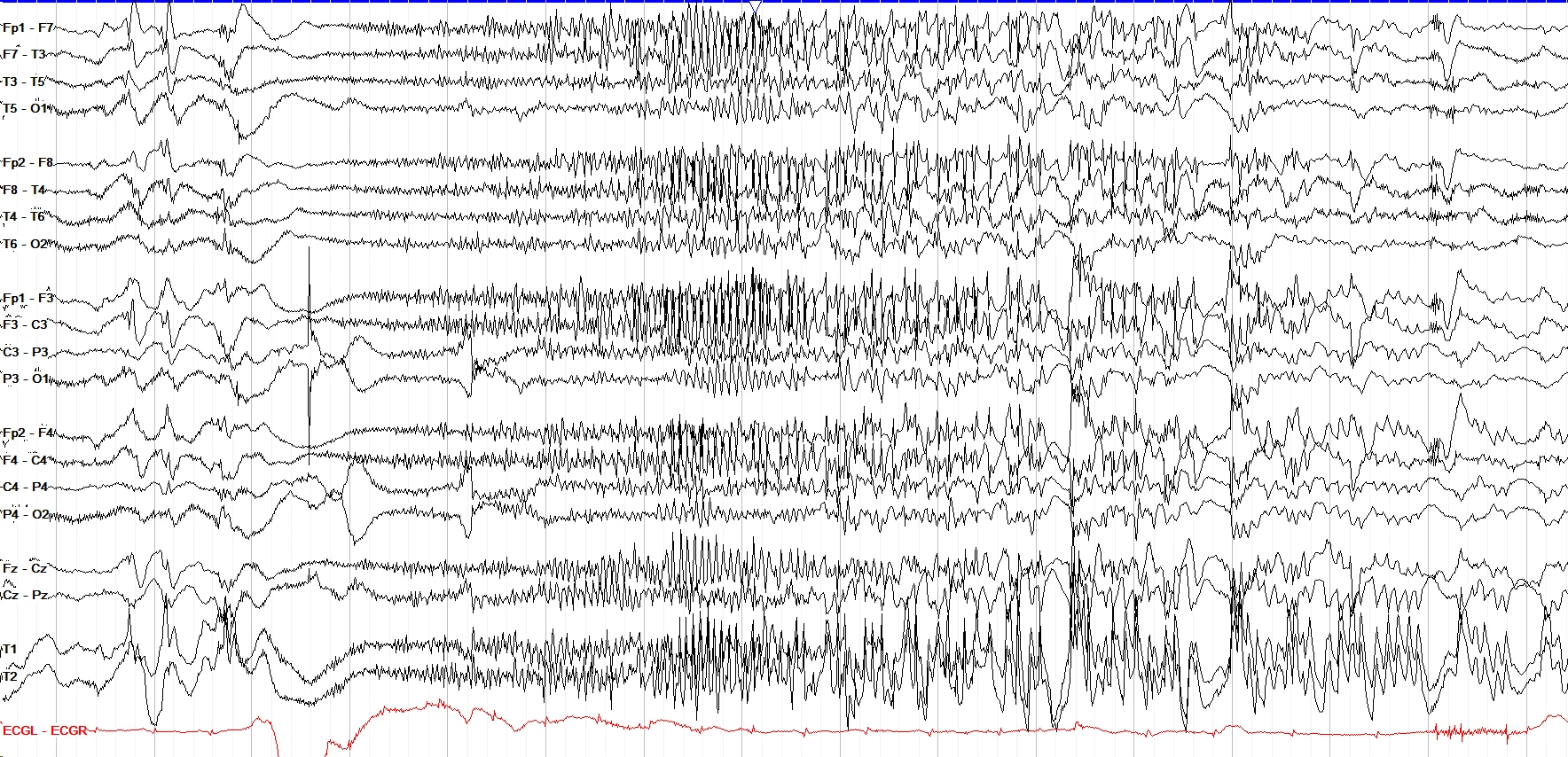 Tonic seizure I EEG OFF