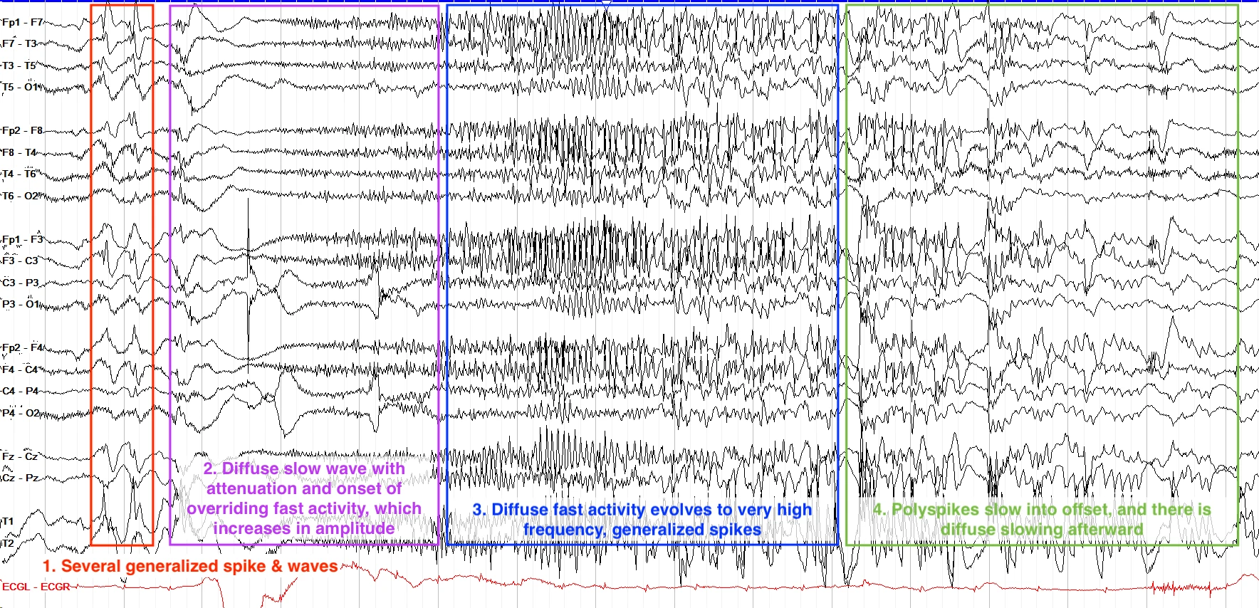 Tonic seizure I EEG ON