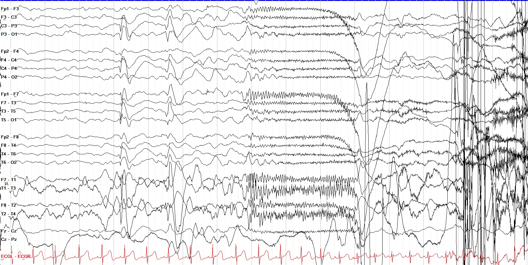 Tonic seizure II EEG OFF