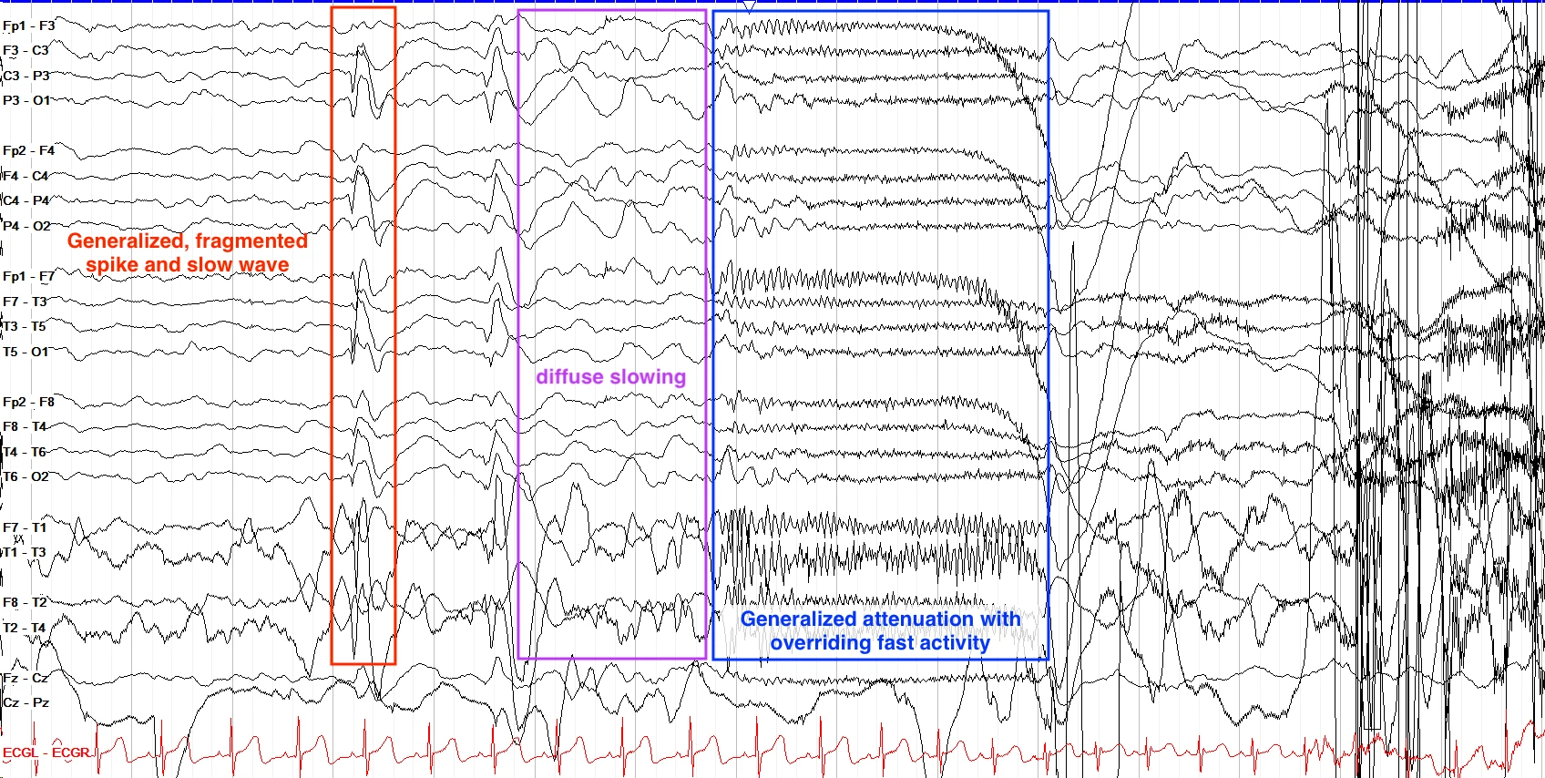 Tonic seizure II EEG ON