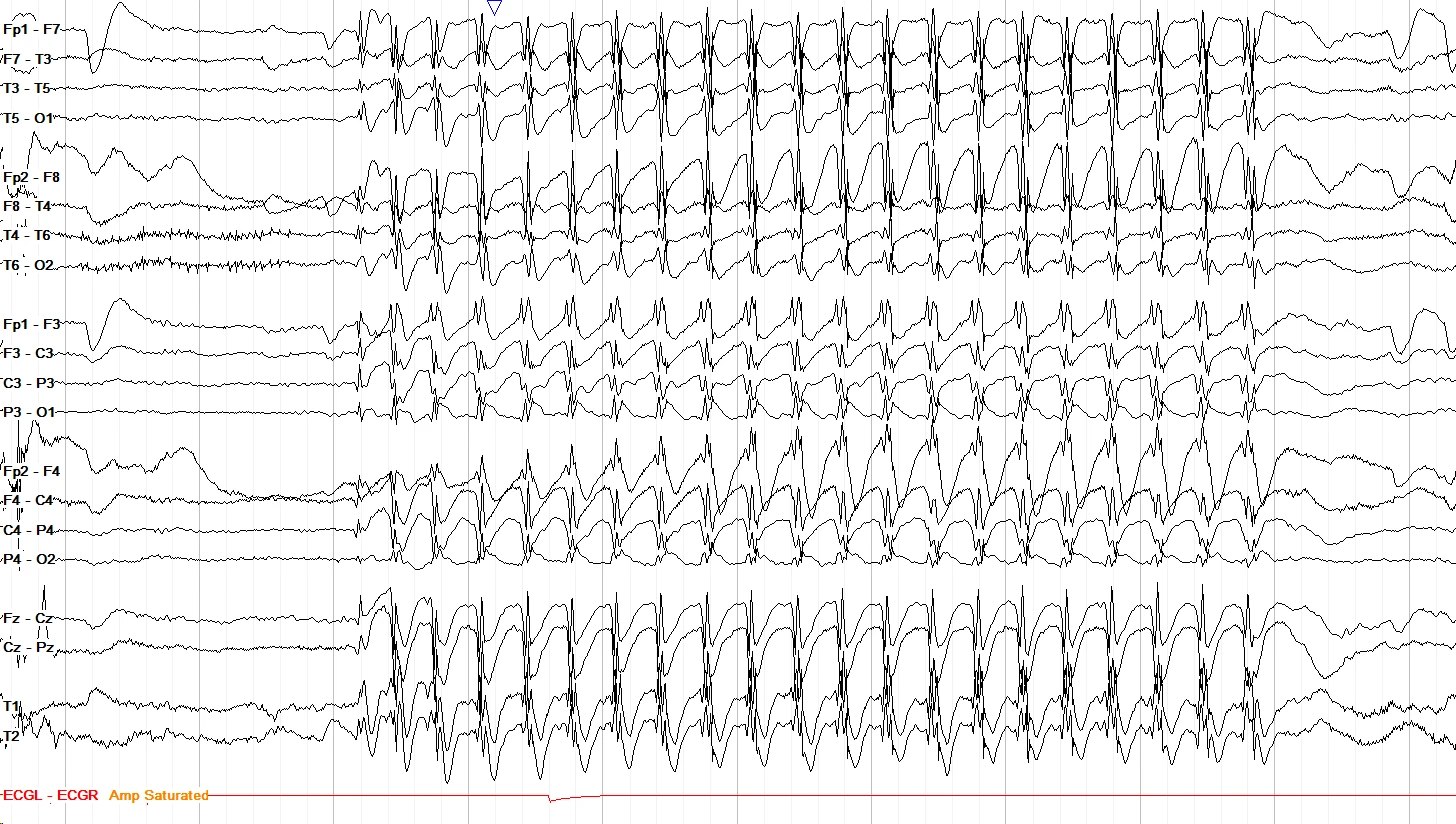 Typical absence seizure EEG OFF