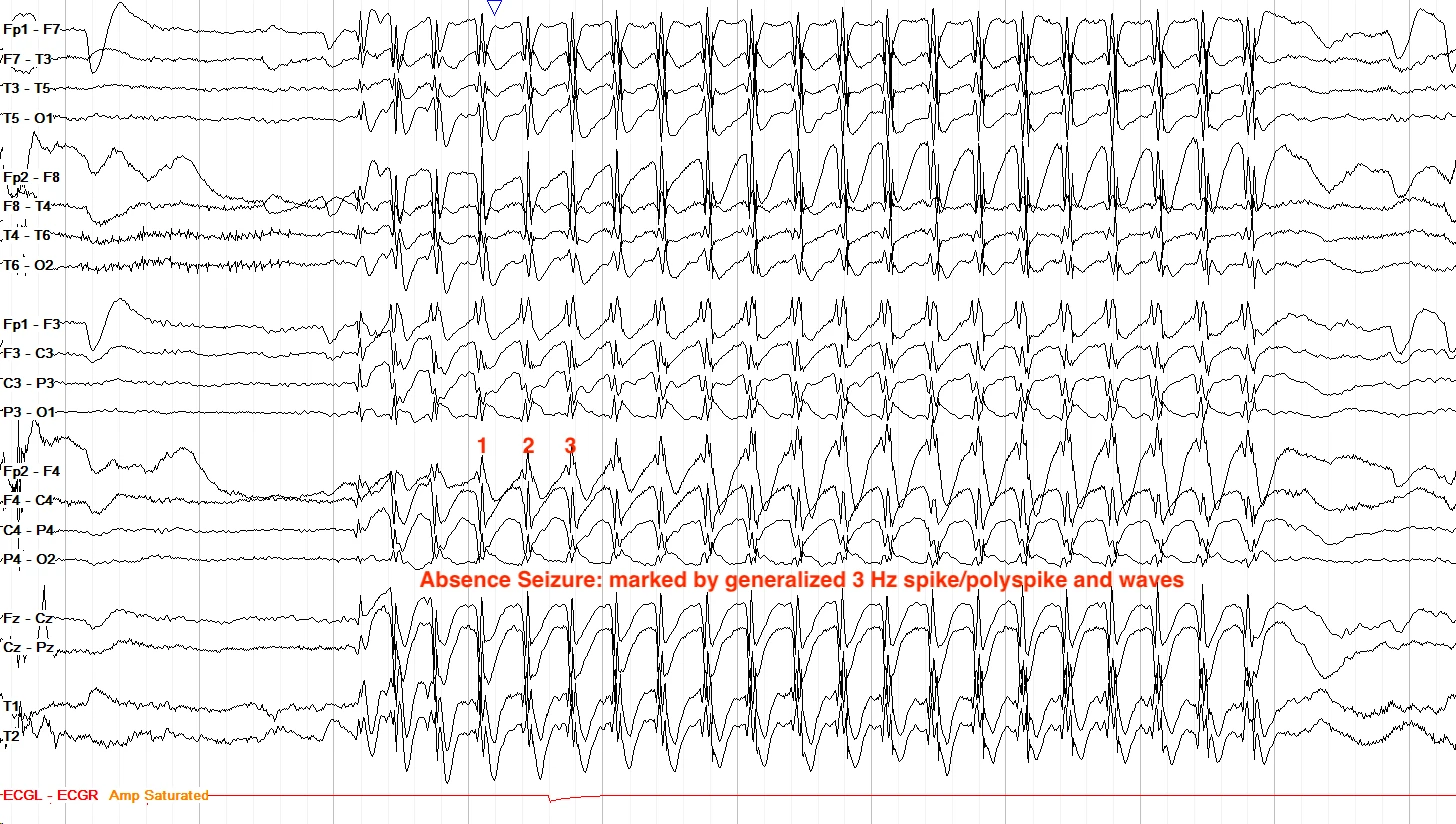 Typical absence seizure EEG ON