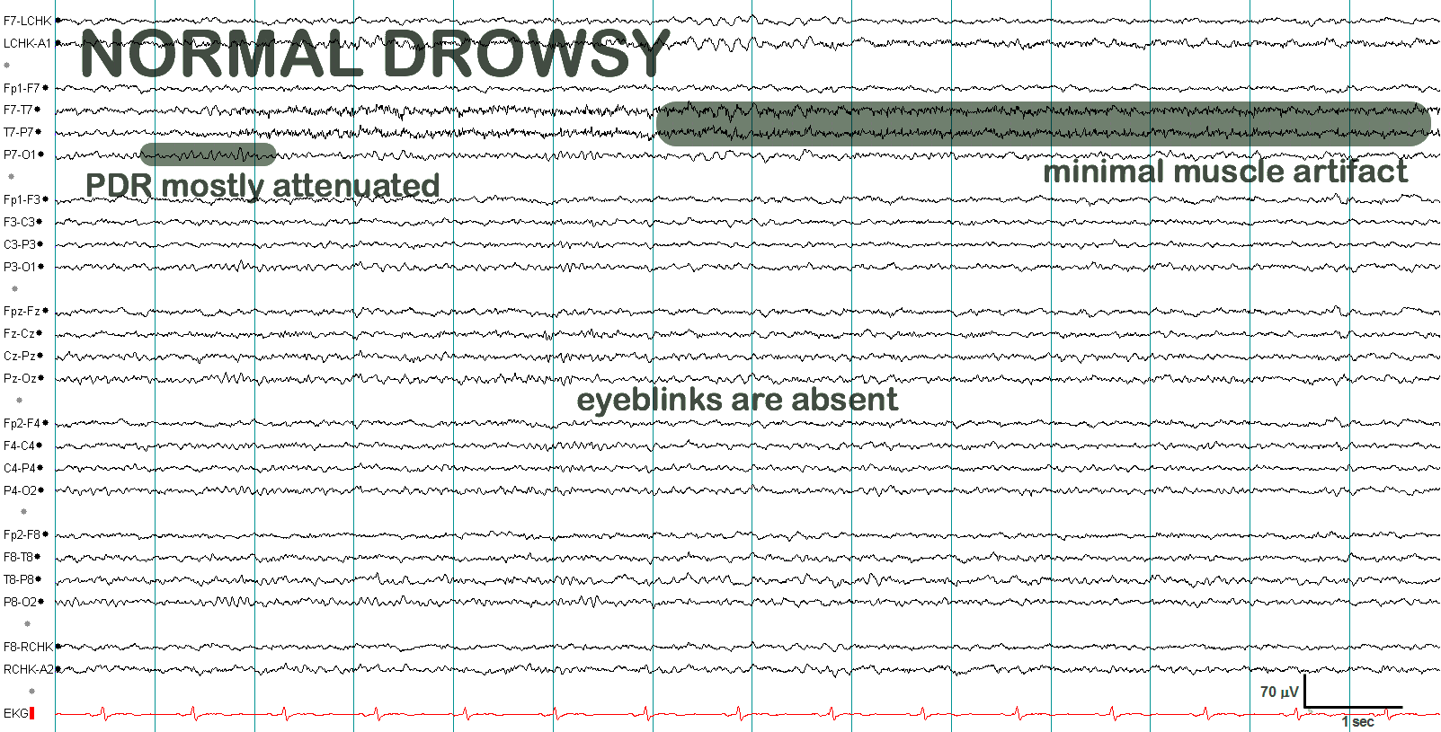 Normal drowsiness EEG annotated