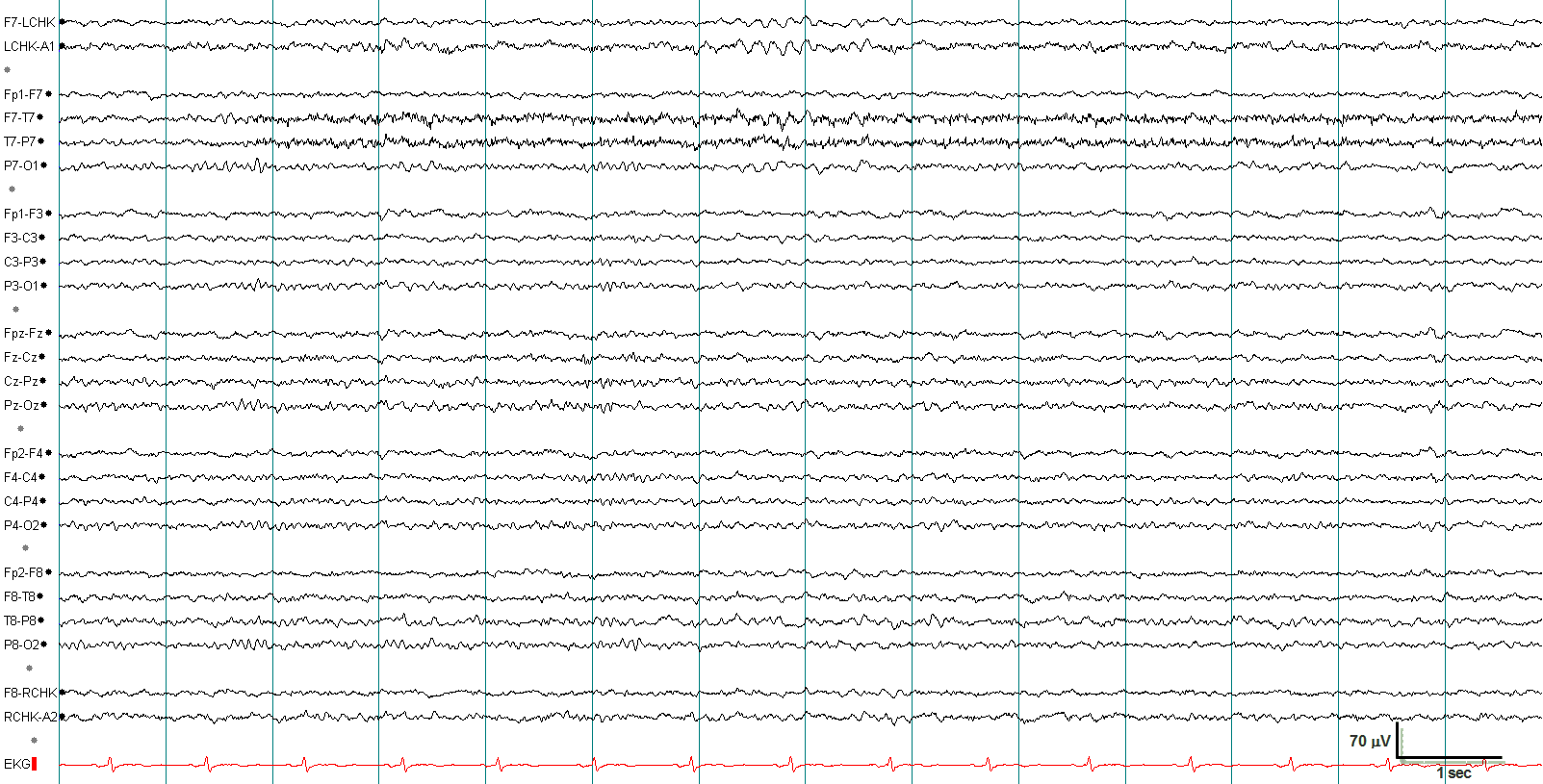 Normal drowsiness EEG without annotations