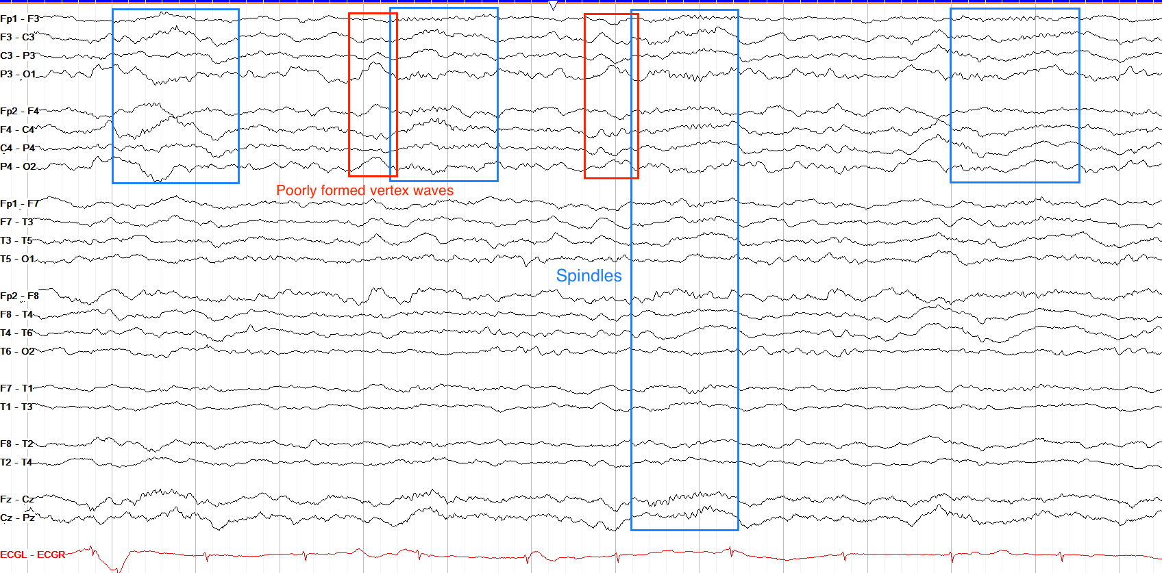 N3 slow-wave sleep EEG